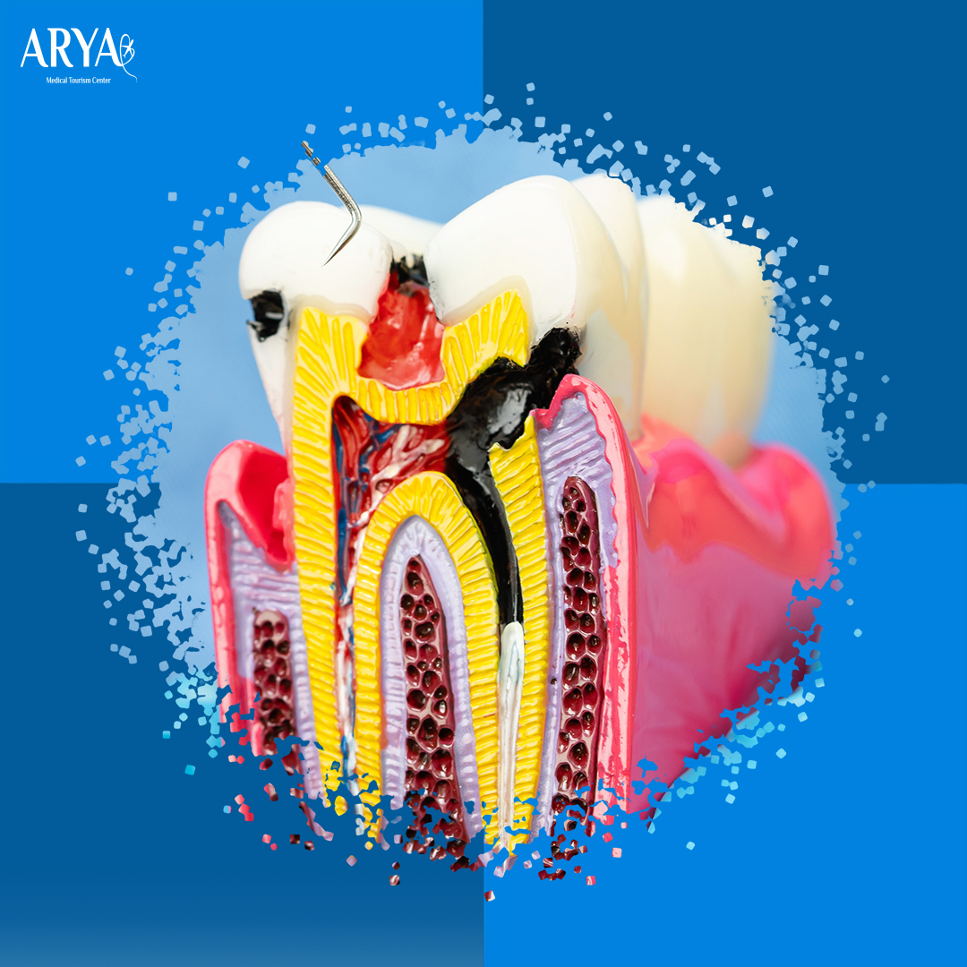Endodontic Treatments